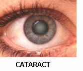 Cataract 