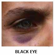 Black Eye