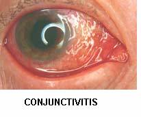 Conjuctivitis