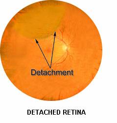 Detached Retina