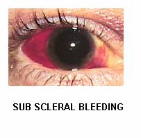 Sub Scleval Bleeding